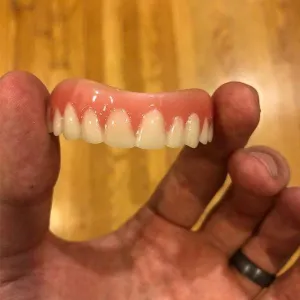 Great Smile Veneer (Upper & Lower)