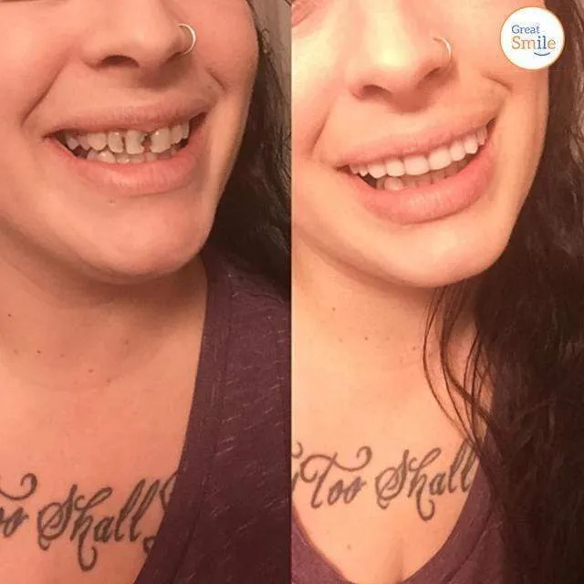 Great Smile Veneer (Upper & Lower)